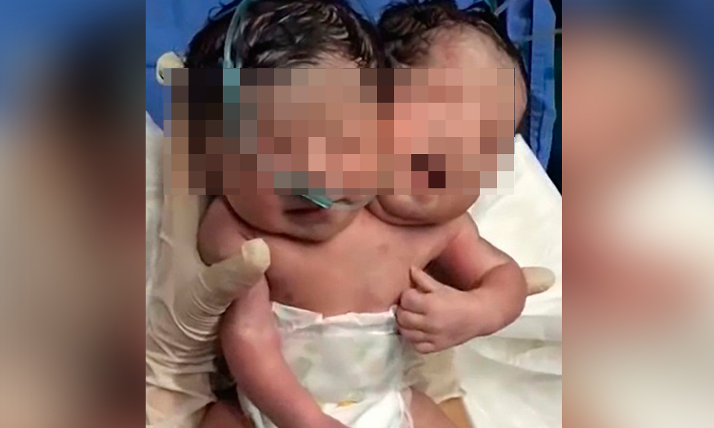 Reportan nacimiento de bebé con dos cabezas en Ciudad Juárez