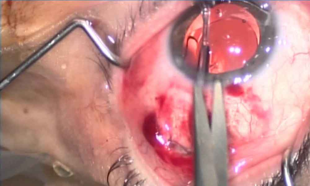 Glaucoma, la segunda causa de ceguera irreversible: IMSS