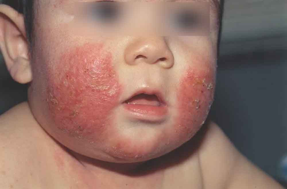 Importante evitar dermatitis en bebés: IMSS