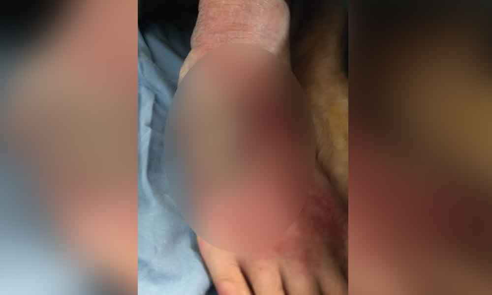 Mordedura de araña provocó la destrucción de su pie en pocas horas