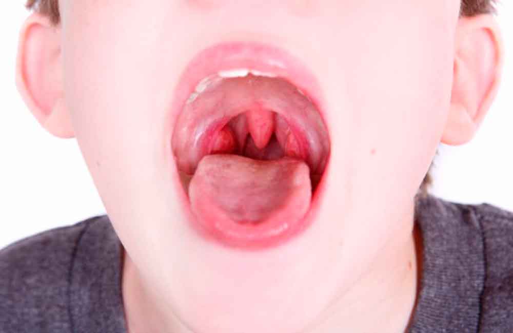Amigdalitis, infección común de garganta: IMSS