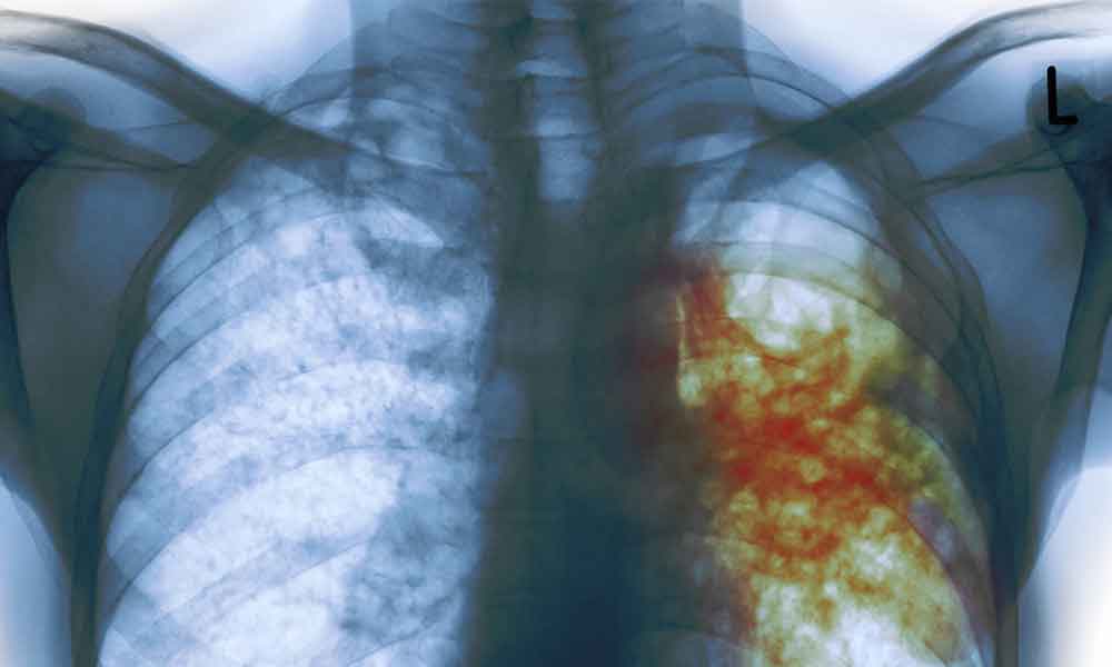 Cada año 700 nuevos casos de tuberculosis en Baja California