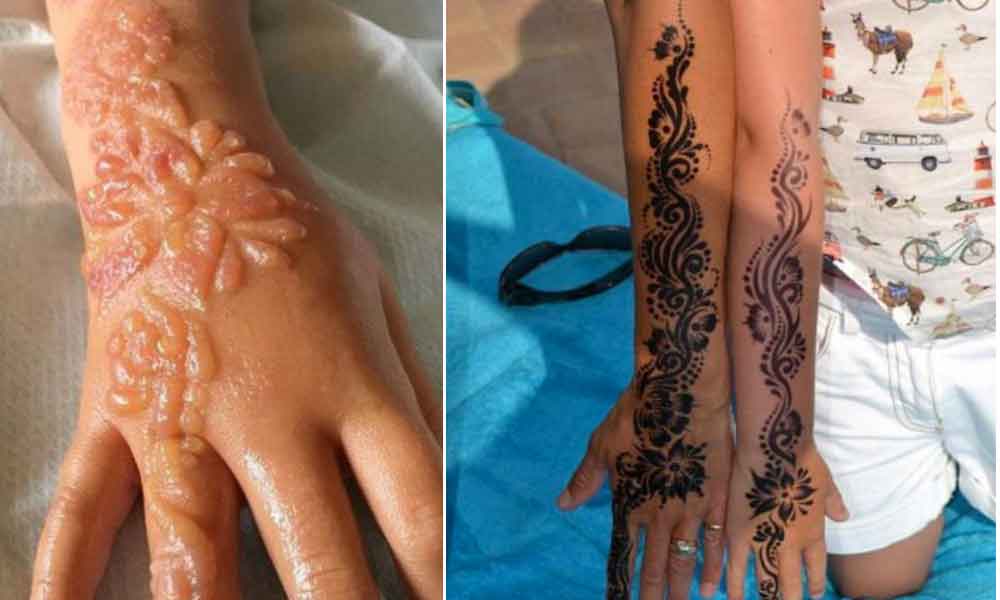 Tatuajes de Henna causan cicatrices en niña de 7 años