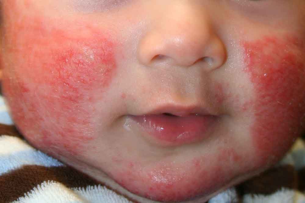 Bebés y niños son más propensos a dermatitis atópica: IMSS