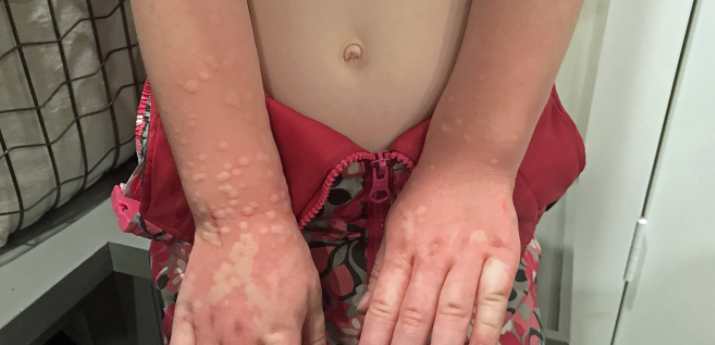 Niña de 5 años padece una extraña alergia al frío