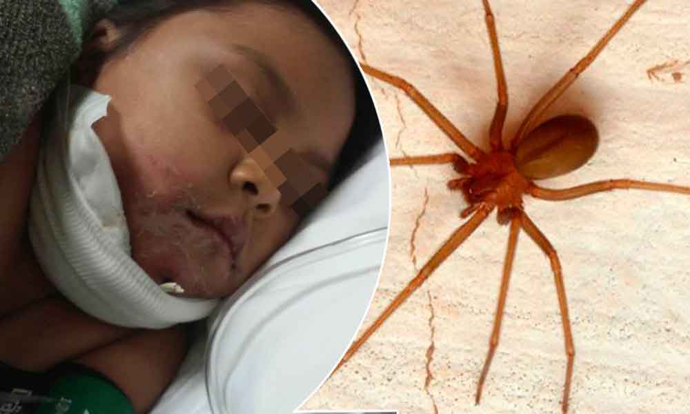 Menor grave tras picadura de araña violinista en Tijuana; urgen donadores de sangre