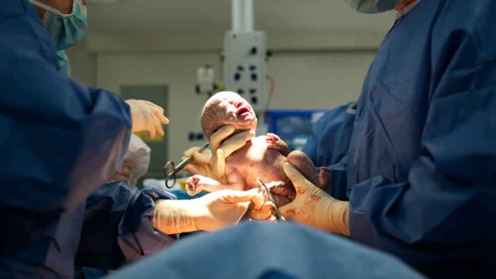 Nacidos por cesárea, propensos a obesidad y asma