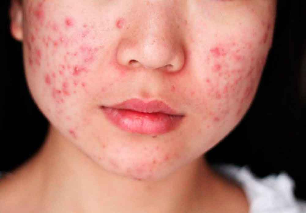 Te decimos 5 remedios naturales para combatir el acné
