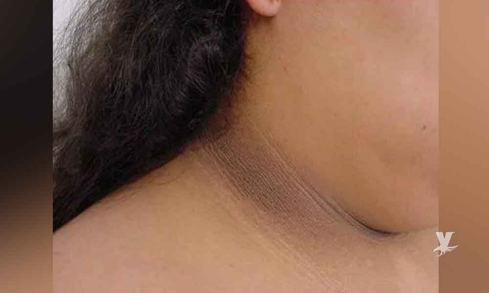 ¿Qué son las manchas oscuras alrededor del cuello?
