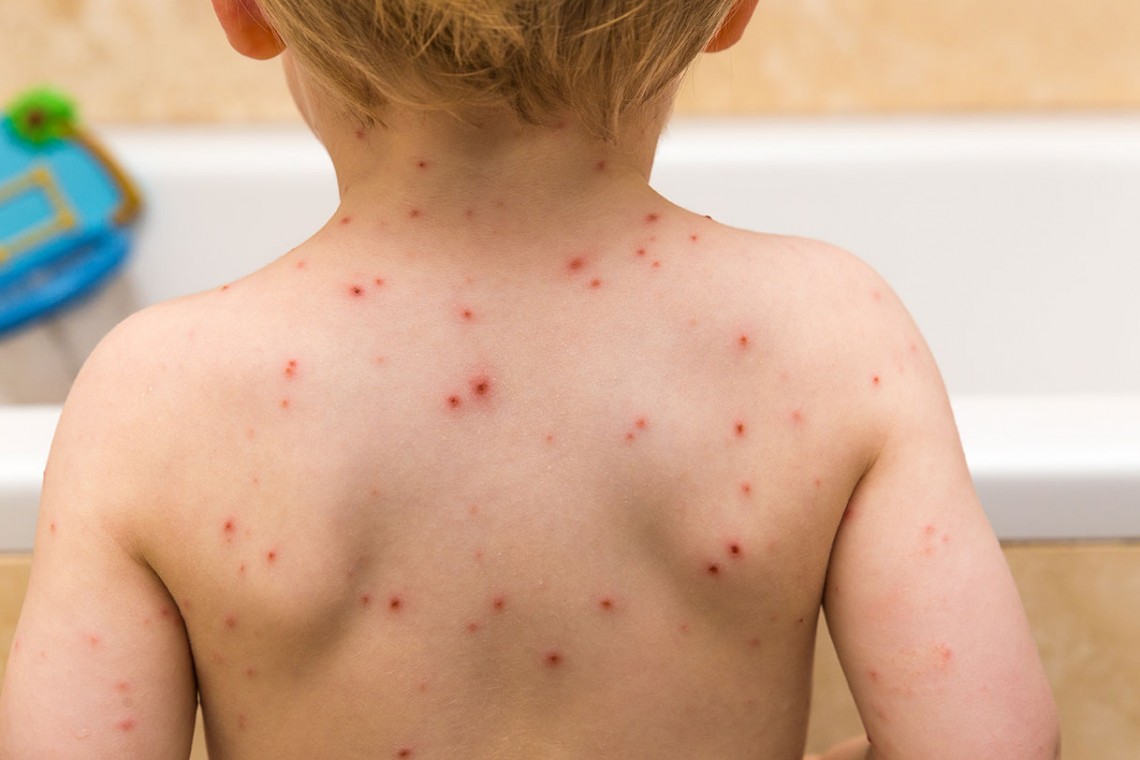 ¡Atención! Remedios caseros que NO debes usar contra la varicela