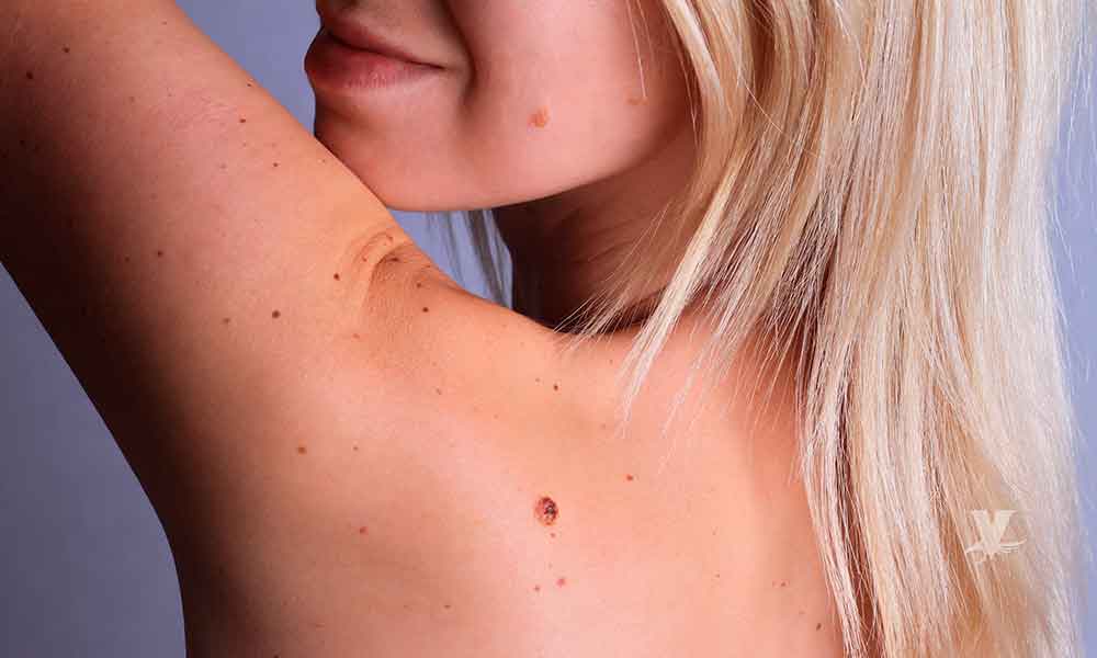 Melanoma, el cáncer de piel más común y peligroso