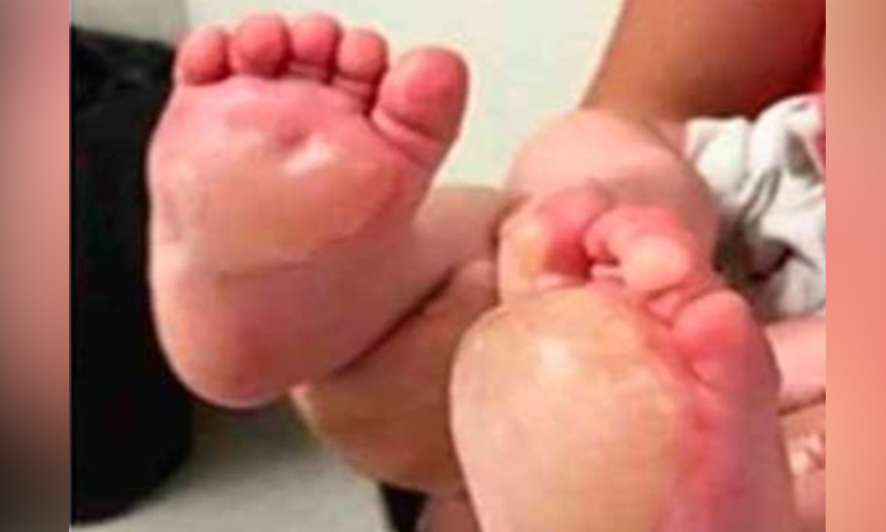 Detienen a padres tras quemarle los pies a niña de dos años