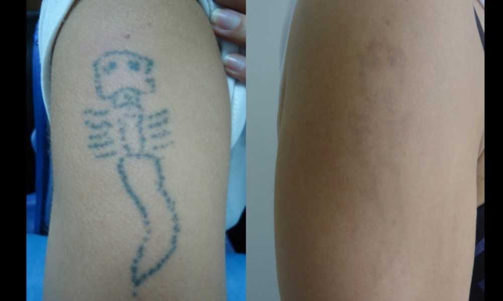 Removerán tatuajes a migrantes de manera gratuita en Tijuana