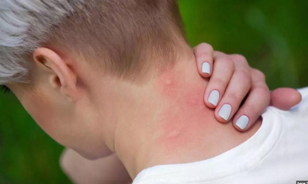Más calor, más mosquitos… esta podría ser la razón por la que los moscos te pican más a ti
