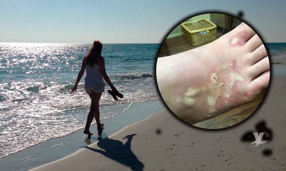 Mujer caminaba por la playa sin saber que un peligroso gusano la infectó, casi pierde las piernas
