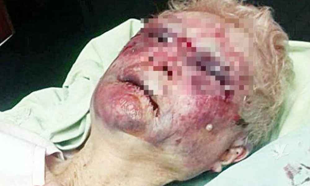 Anciana es golpeada en asilo; autoridades del lugar indican que la mujer calló de la cama