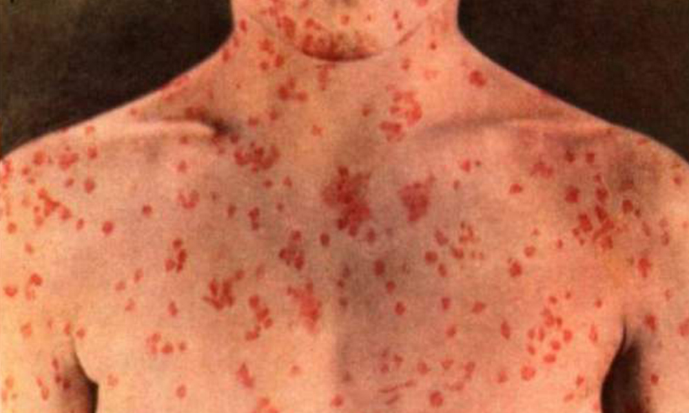 Emite UNAM recomendaciones preventivas ante nuevo brote global de sarampión