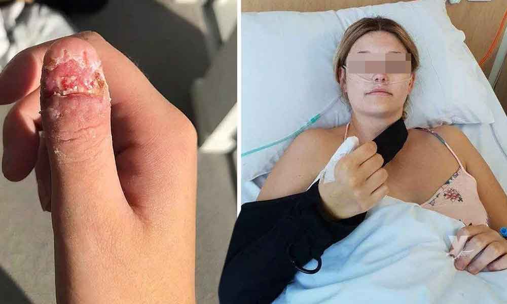 Mujer sufre amputación del dedo pulgar por hábito nervioso de morderse las uñas