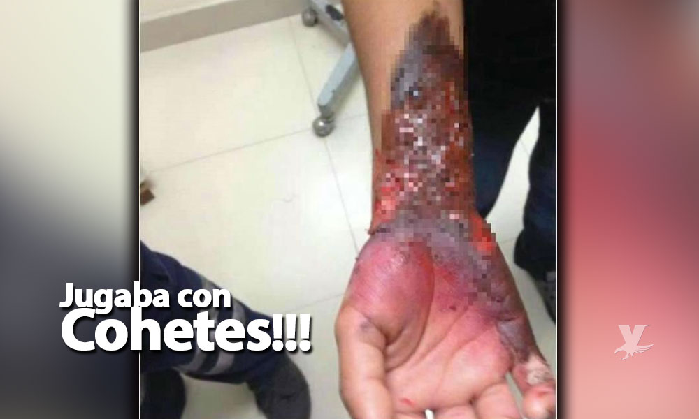 Menor sufrió quemaduras en su brazo al explotarle un cohete