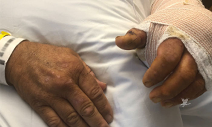 Hombre es hospitalizado luego de contraer bacteria carnívora en el Golfo de México