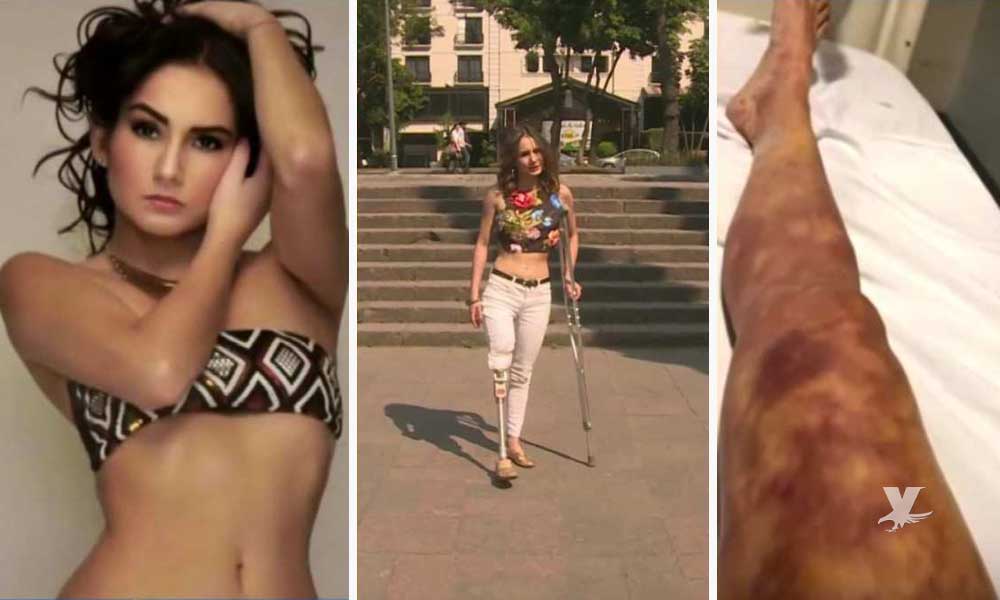 (VIDEO) Famosa modelo venezolana sufrió la amputación de una pierna por negligencia en un hospital de México