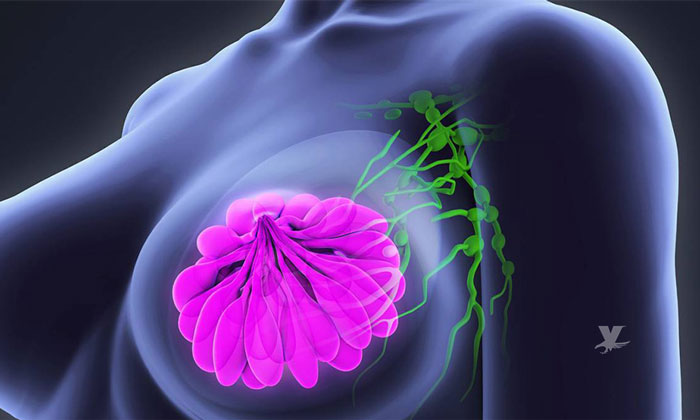 Conoce las señales que podrían detonar el cáncer de mama