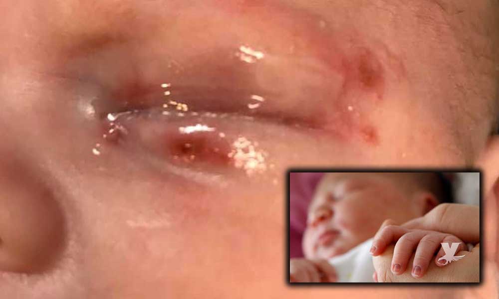 Bebé es contagiado de herpes durante su bautizo debido a los besos que recibió