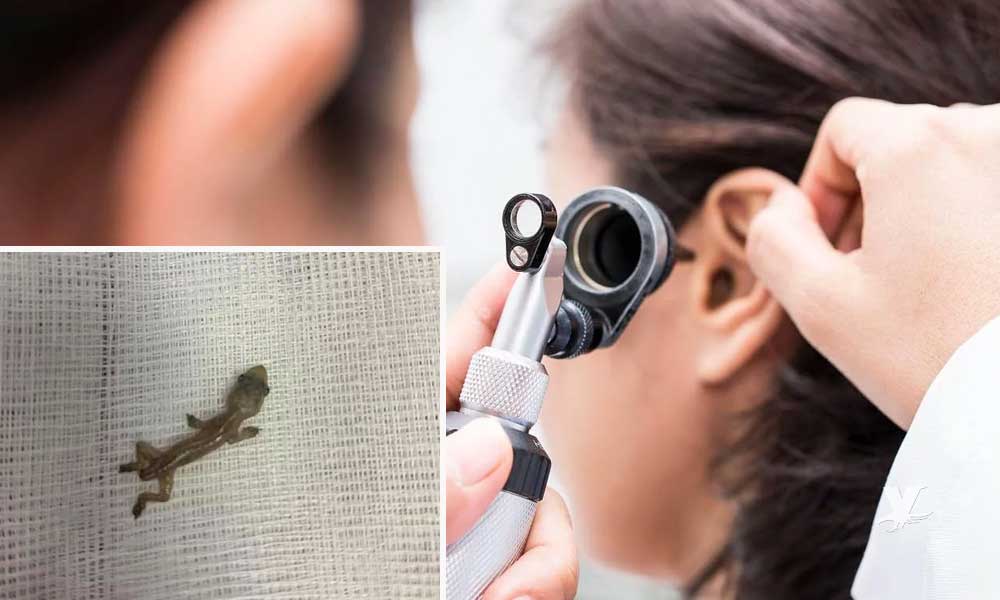 Hombre fue a revisión por dolor en un oido y le sustrajeron una lagartija