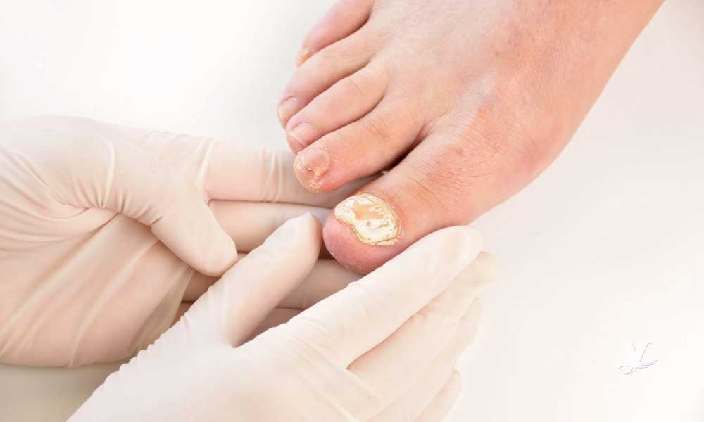 Usar zapatos inadecuados crea lesiones en las uñas que pueden causar amputaciones